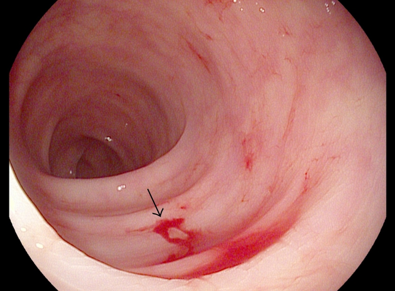 Chảy máu thường xảy ra trên niêm mạc ống tiêu hóa đã bị tổn thương trước đó trong quá trình đặt ống thông tá tràng