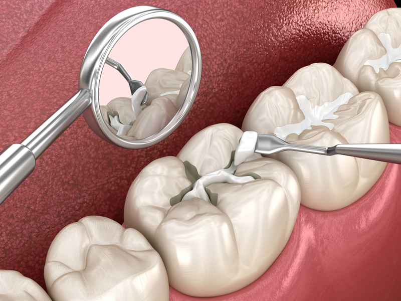 Các bác sĩ sẽ thực hiện trám răng bằng chất liệu gì?2