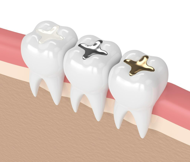 Các bác sĩ sẽ thực hiện trám răng bằng chất liệu gì?3