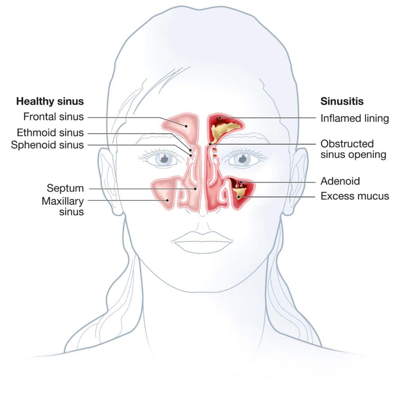 Các bệnh lý nào thường xảy ra ở đường hô hấp trên? 4
