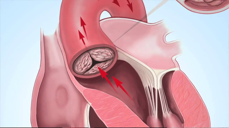 Các bệnh lý về van bán nguyệt 3