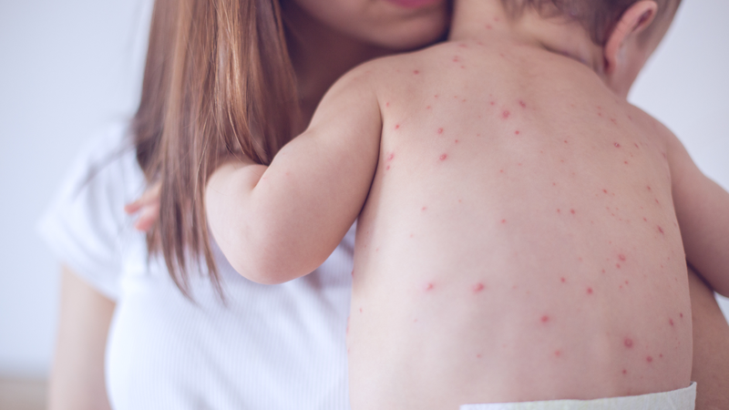 Các bệnh lý viêm da virus ở trẻ em và biện pháp phòng ngừa viêm da virus 2