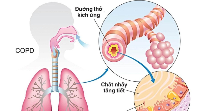 Các bệnh về hô hấp thường gặp và cách phòng ngừa 3