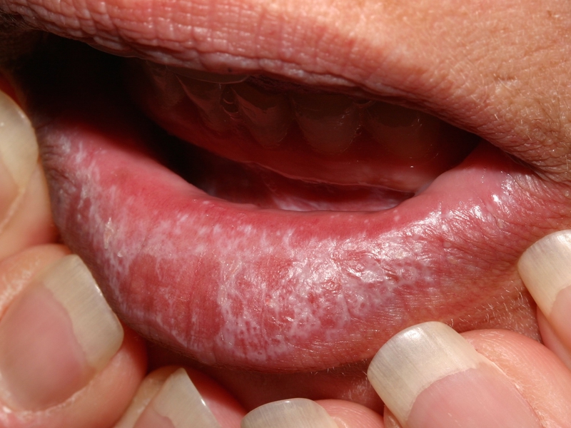 Các bệnh về lưỡi thường gặp: Nguyên nhân, triệu chứng và hướng điều trị 5