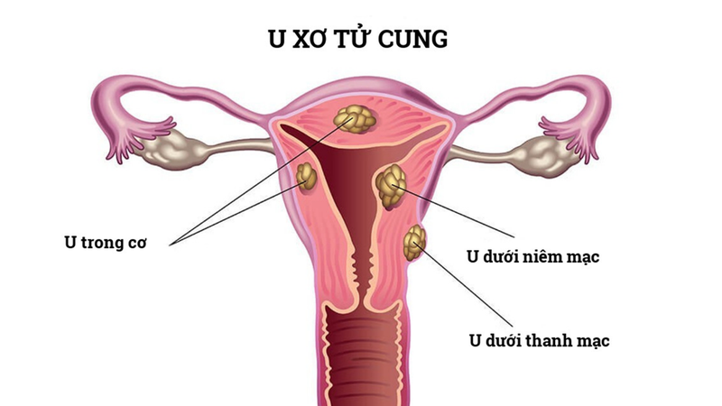 Top các bệnh về tử cung thường gặp và cách phòng ngừa 2