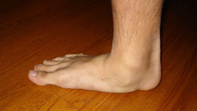 Các dị tật ở chân thường gặp ở trẻ sơ sinh 3