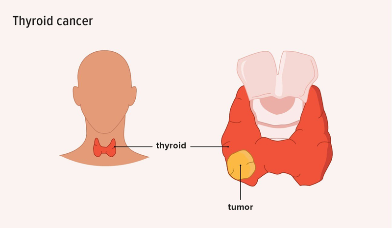 Các giai đoạn ung thư tuyến giáp và cách phân loại giai đoạn ung thư 3