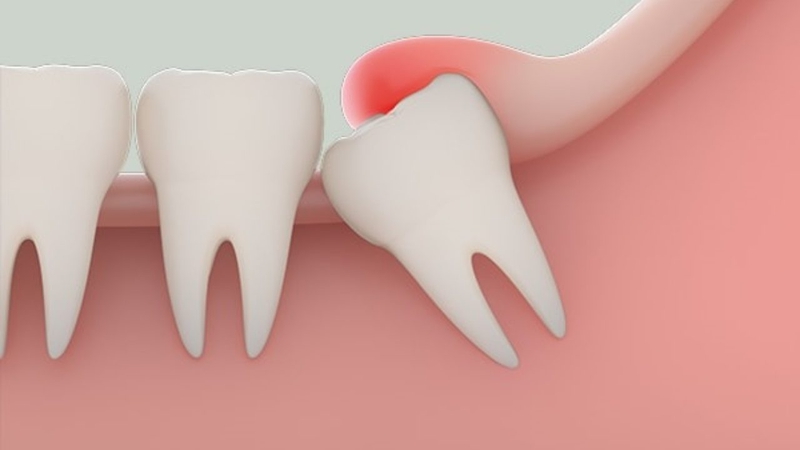 Các kiểu răng khôn mọc lệch thường gặp-2