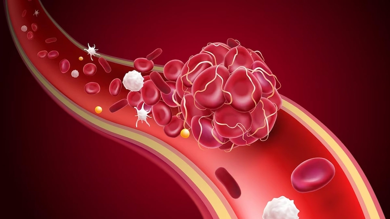 Các loại cục máu đông thường gặp và quá trình hình thành cục máu đông 2