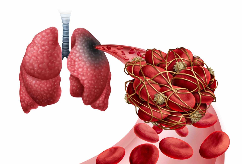 Các loại cục máu đông thường gặp và quá trình hình thành cục máu đông 4