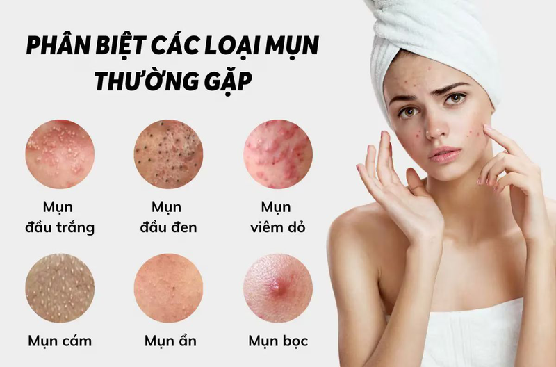 Các Loại Mụn Trên Khuôn Mặt: Nguyên Nhân, Cách Điều Trị Hiệu Quả