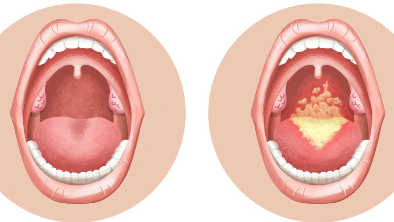 Các loại nấm gây bệnh trên người -4