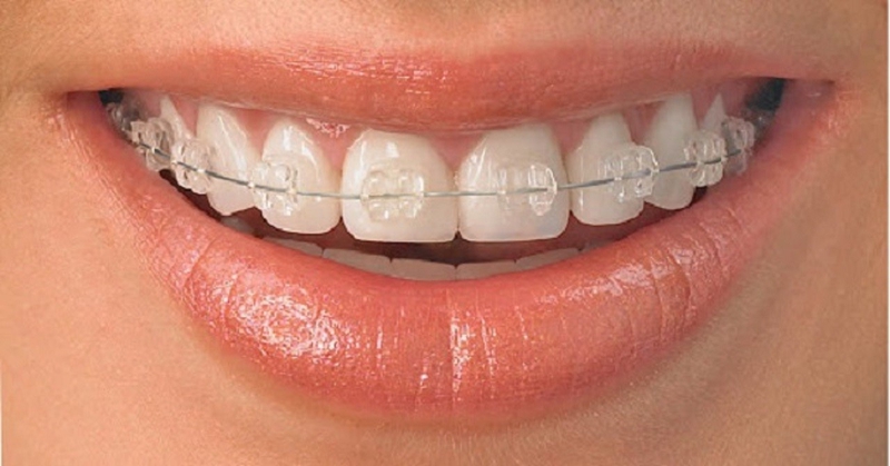 Các loại niềng răng phổ biến hiện nay 4