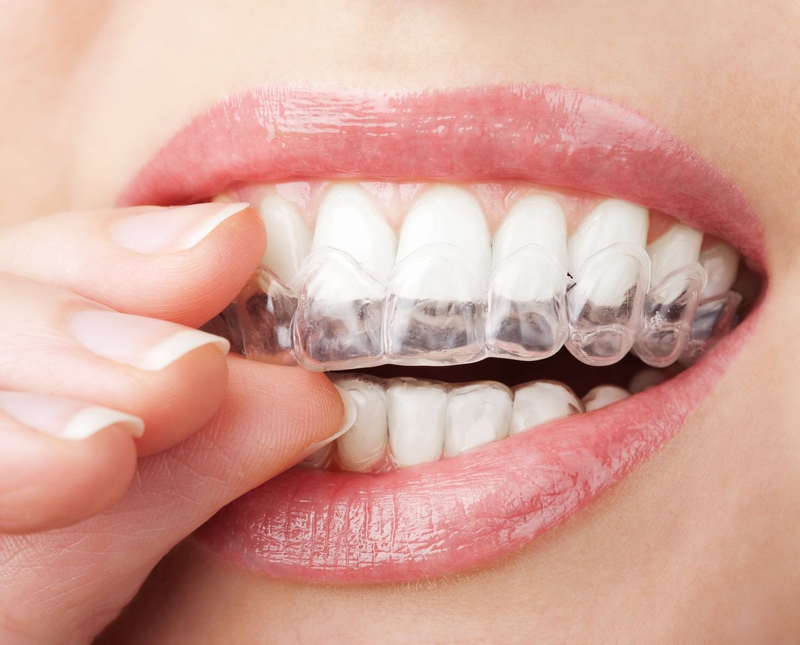 Các loại niềng răng phổ biến hiện nay 5