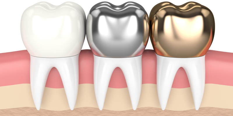 Các loại răng sứ thẩm mỹ phổ biến hiện nay 2