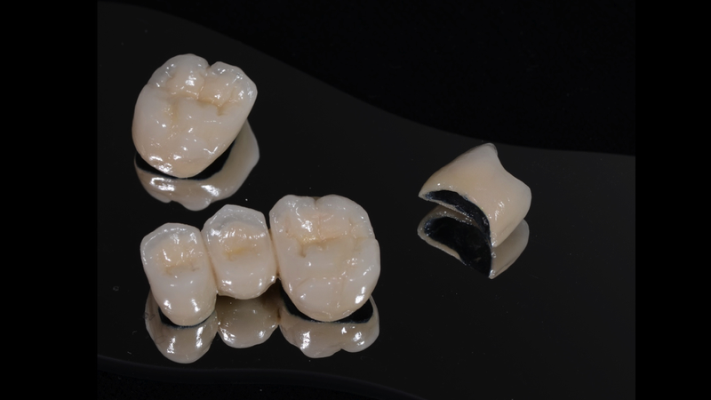 Các loại răng sứ thẩm mỹ phổ biến hiện nay 3