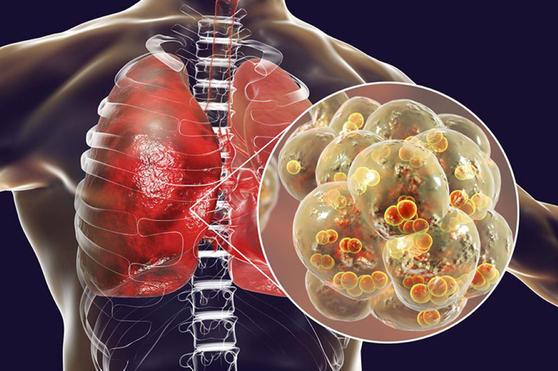 Các nhà nghiên cứu tạo ra loại thuốc mới có thể ngăn ngừa tổn thương phổi do cúm 1