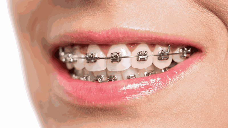Các phương pháp niềng răng thẩm mỹ hiện nay 2