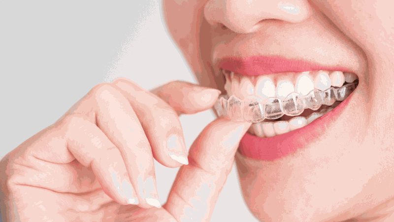 Các phương pháp niềng răng thẩm mỹ hiện nay 3