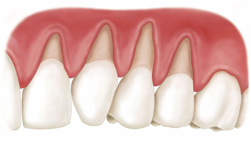 Các phương pháp thực hiện ghép nướu răng hiện nay 2