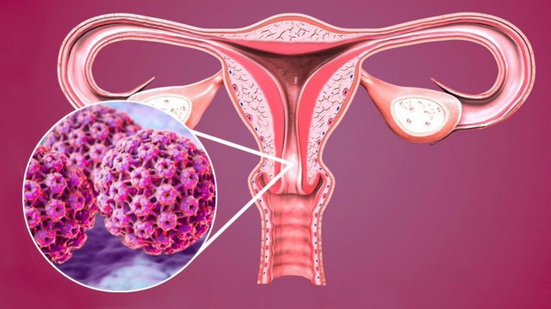 Các phương pháp xét nghiệm sàng lọc ung thư cổ tử cung 1