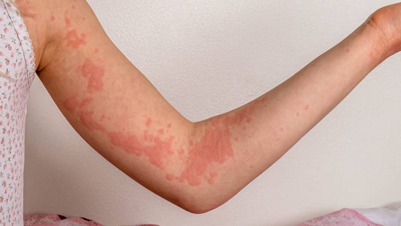 Các tác dụng phụ của thuốc kháng sinh liều cao​ 1