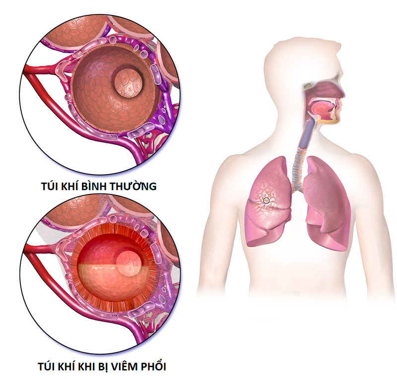 Các tiêu chuẩn chẩn đoán viêm phổi-2