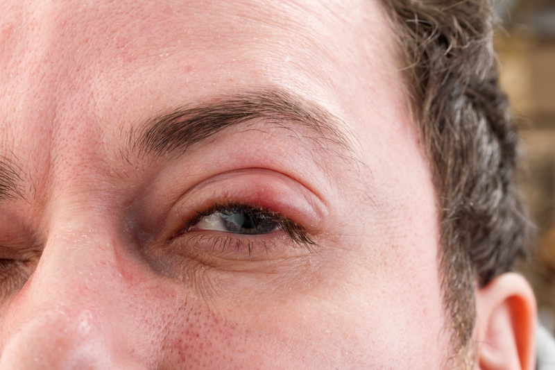 Các triệu chứng đau mắt hột mà bạn nên biết 2