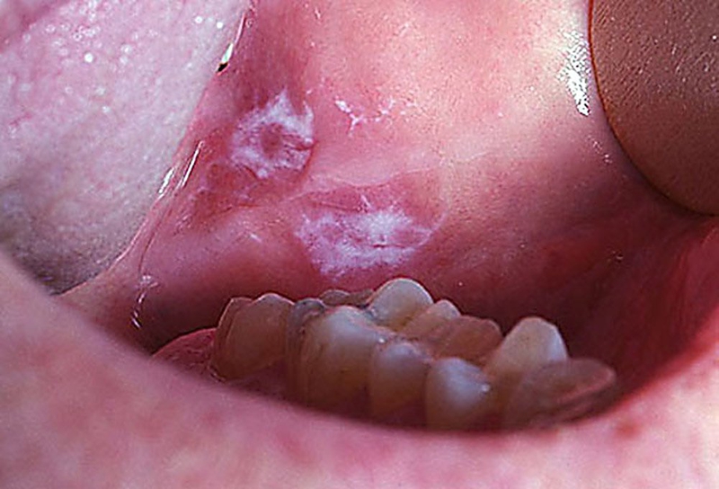 Các yếu tố nguy cơ của ung thư lưỡi 3