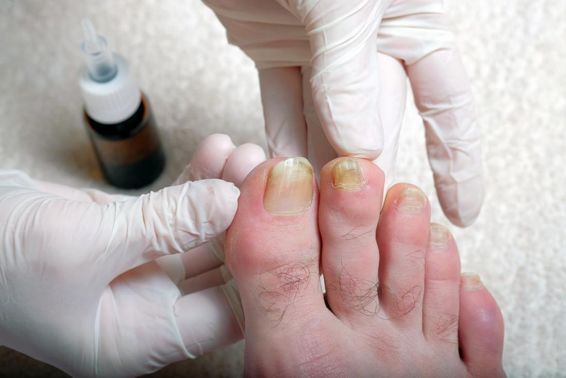 Cách chữa móng chân bị bầm tím giúp vết thương nhanh hồi phục - 3