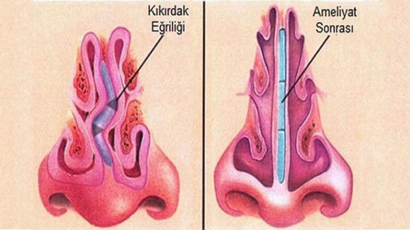 Tìm hiểu về cách chữa vẹo vách ngăn mũi không cần phẫu thuật 1