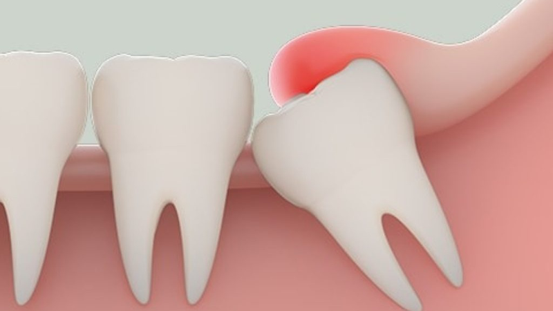 Cách chữa viêm lợi trùm tại nhà 1.jpg