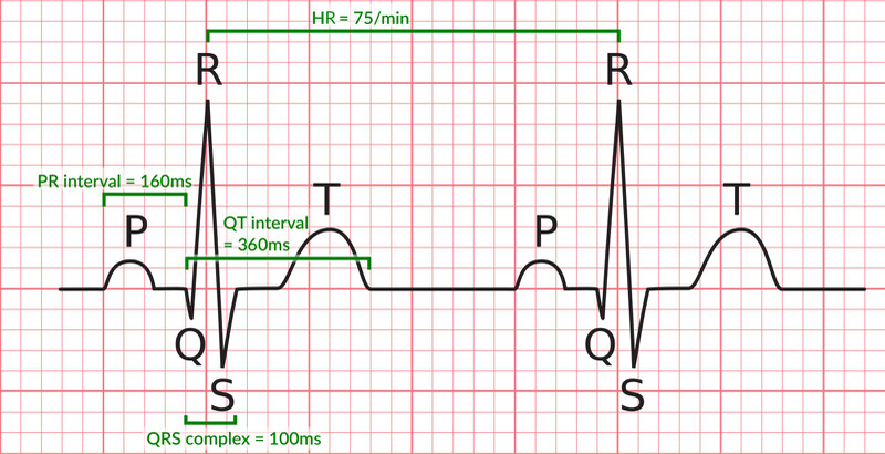 Phức bộ QRS là thành phần quan trọng nhất của điện tâm đồ