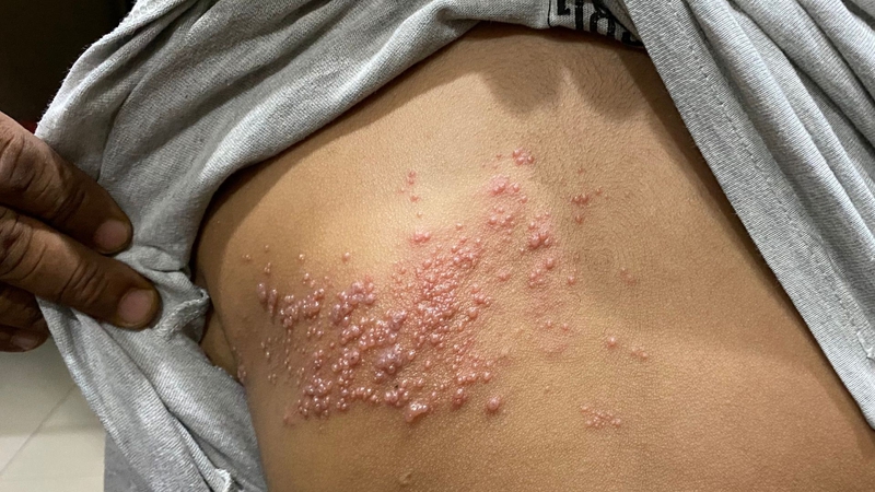 Cách dùng thuốc bôi zona thần kinh acyclovir-1