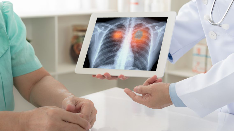 Cách kiểm tra ung thư phổi tại nhà đơn giản, ai cũng có thể áp dụng 4