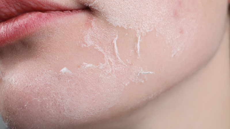 Tuyệt đối không được tự ý dùng tay bóc các mảng da bị bong ra khiên da bị viêm