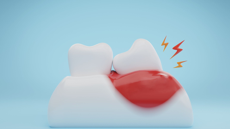 Cách làm giảm sưng nướu răng khôn, hạn chế đau nhức 1