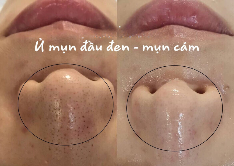 Có nên lấy nhân mụn không? Cách lấy nhân mụn không cần nặn 3