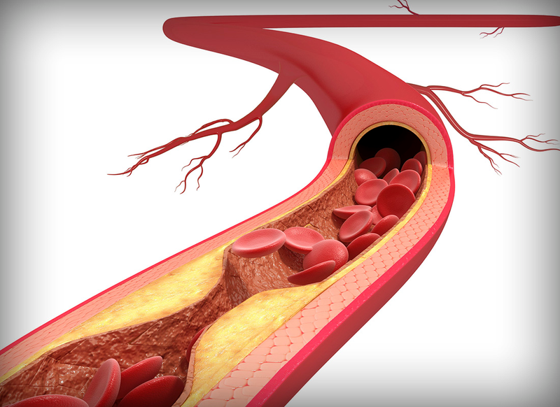 Cách nhận biết xơ cứng động mạch hay xơ vữa động mạch? 3