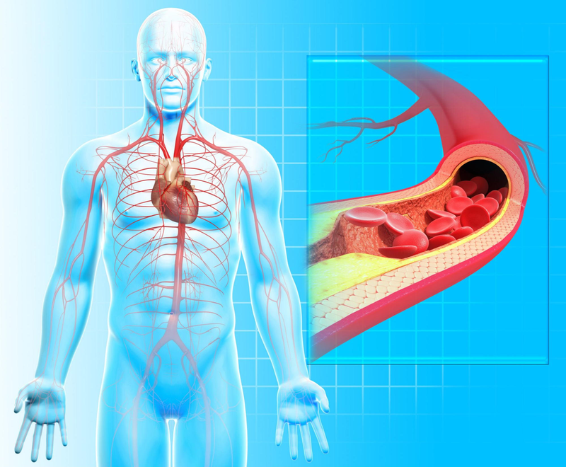 Cách nhận biết xơ cứng động mạch hay xơ vữa động mạch? 1