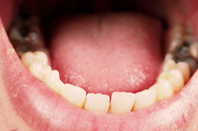 Cách nhổ răng hàm bị sâu tại nhà thế nào? Có an toàn không 1