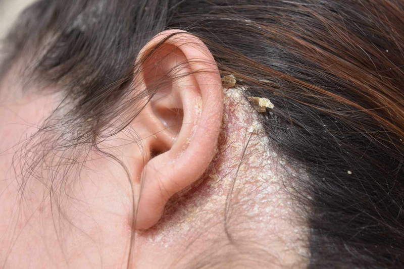 Cách phân biệt gàu và nấm da đầu để tránh nhầm lẫn 2