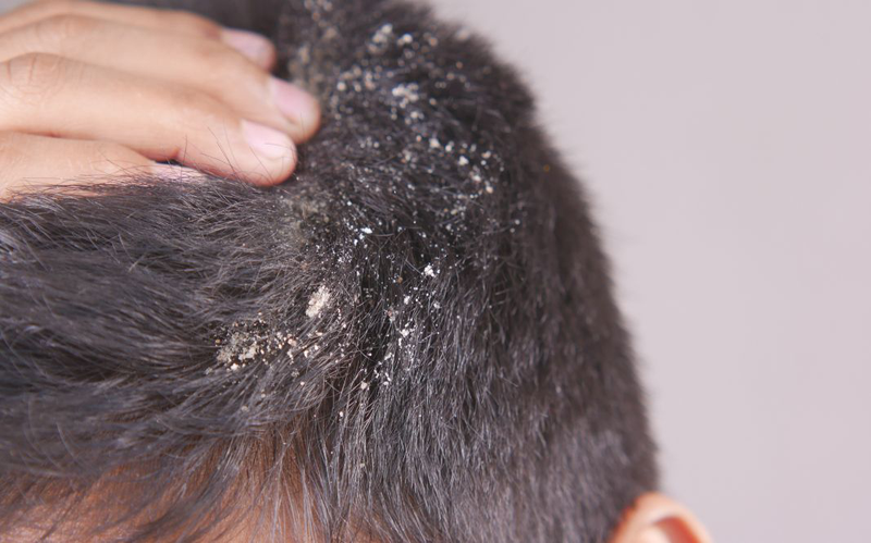 Cách trị đổ mồ hôi đầu ở người lớn​: Giải pháp đơn giản nhưng hiệu quả 3