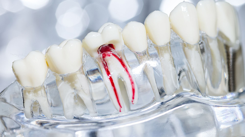 Cắm chốt răng là gì và tại sao lại cần thiết sau khi điều trị tủy? 3