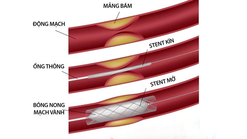 Can thiệp mạch vành là gì? Các chỉ định cần can thiệp mạch vành? 4