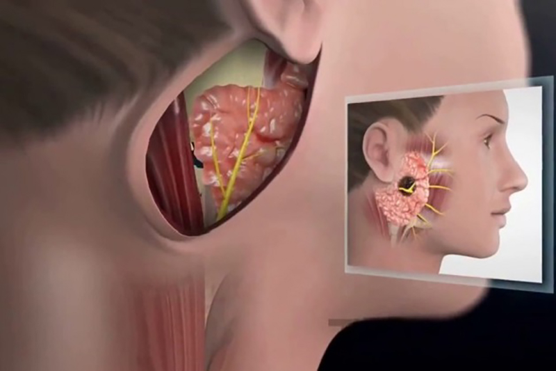 Cắt tuyến mang tai có gây nguy hiểm cho dây thần kinh số VII không? 3