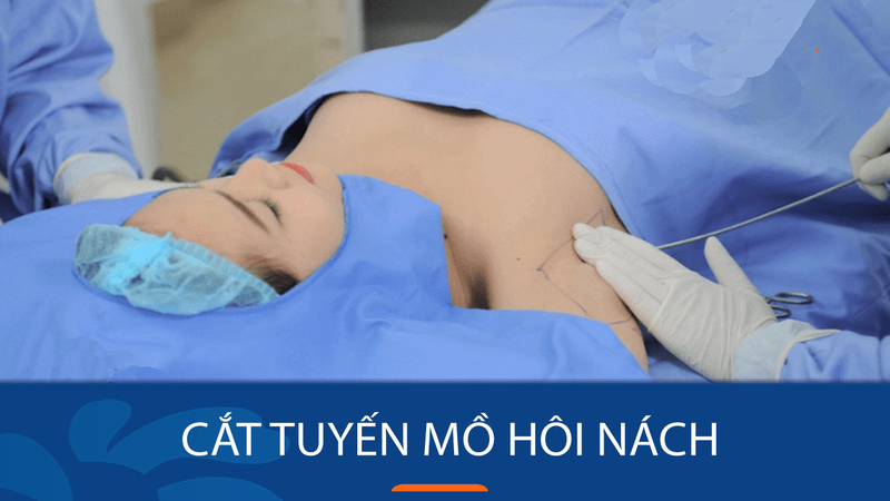 Hiện nay có 3 phương pháp phẫu thuật cắt tuyến mồ hôi nách chính