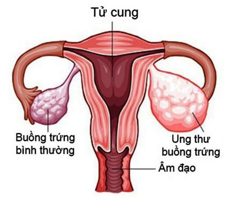 Cấu tạo buồng trứng bạn cần biết -5