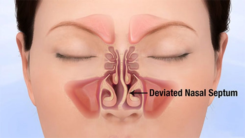 Cấu trúc, chức năng của mũi và những bệnh lý liên quan 4