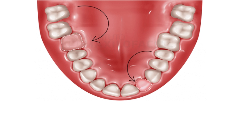 Cấy chuyển răng là gì? Cấy chuyển răng diễn ra như thế nào? 1